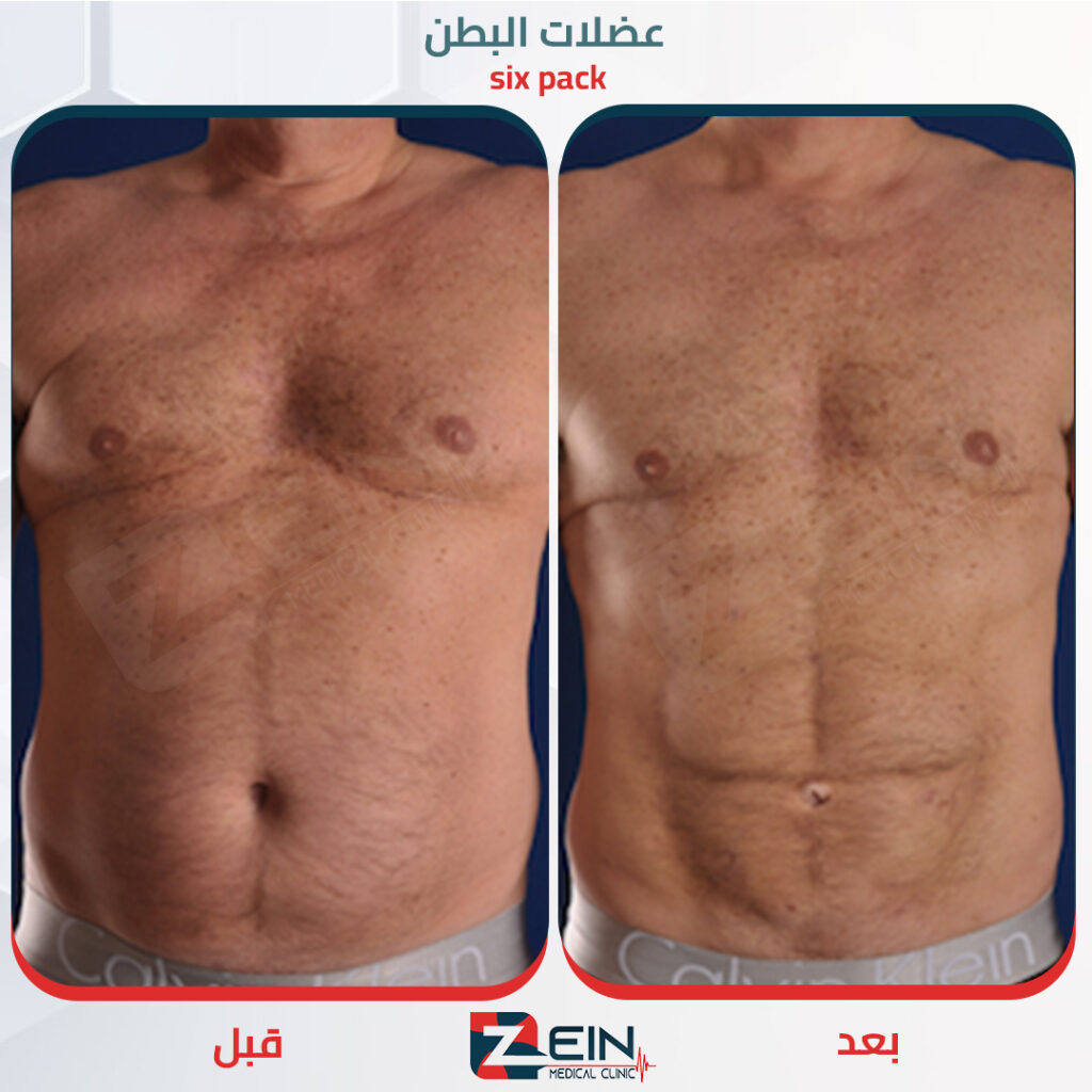 شد وشفط الدهون