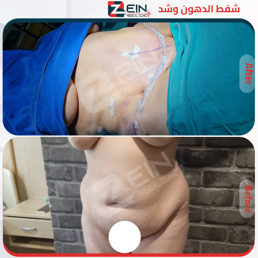 شفط دهون وشد جلد
