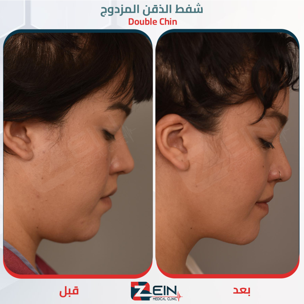 شد وجه و رقبة