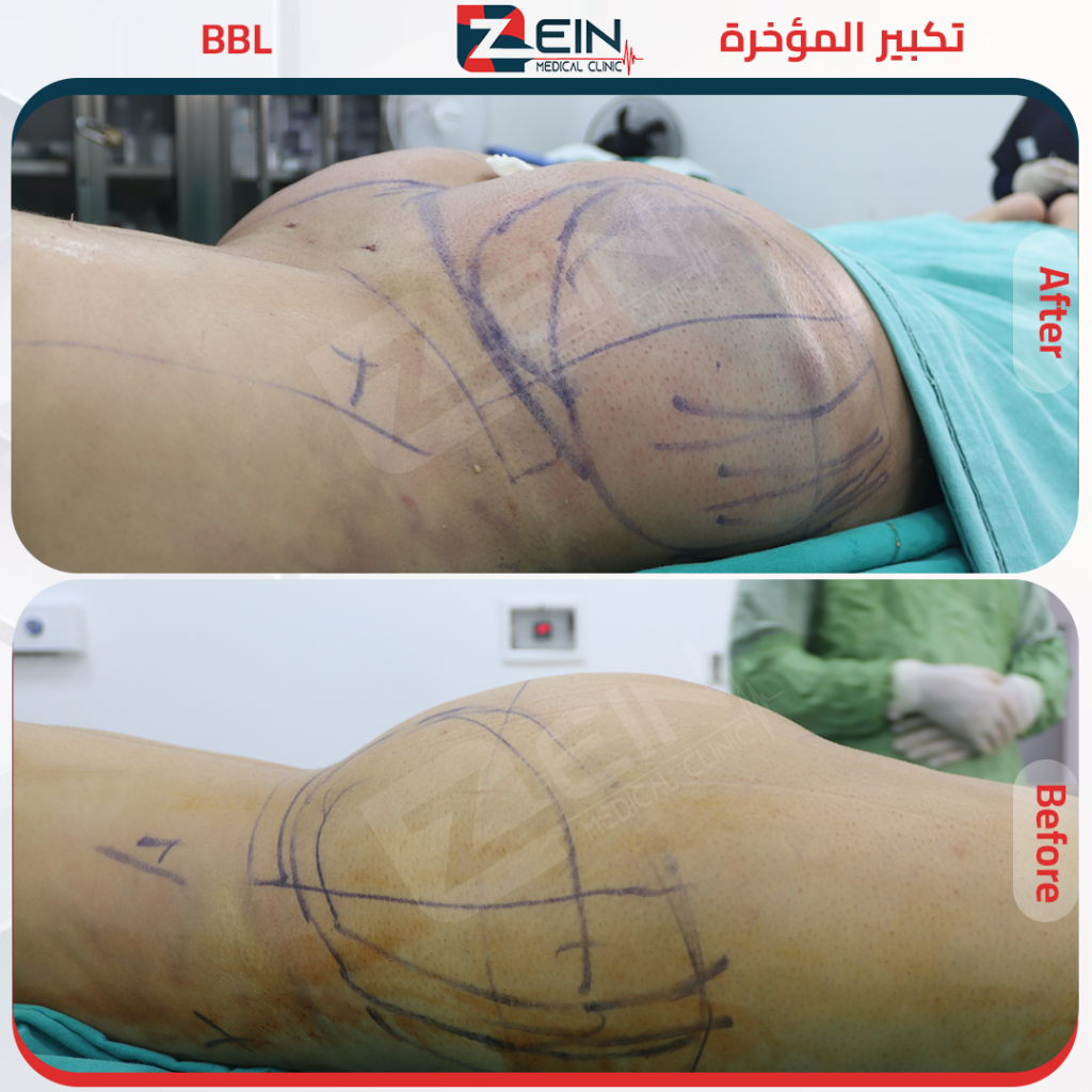 المؤخرة البرازيلية