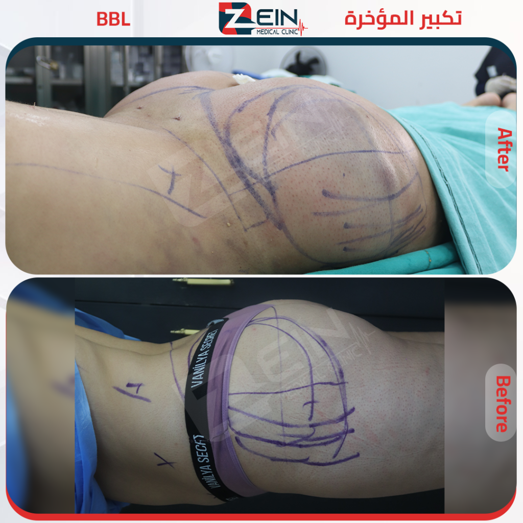 المؤخرة البرازيلية