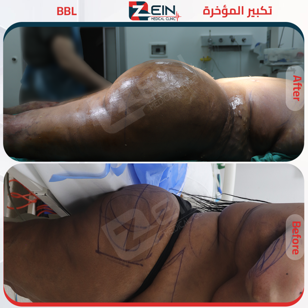 المؤخرة البرازيلية