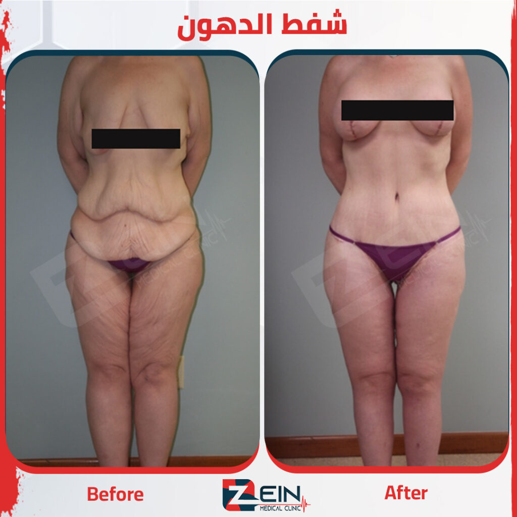 شفط الدهون