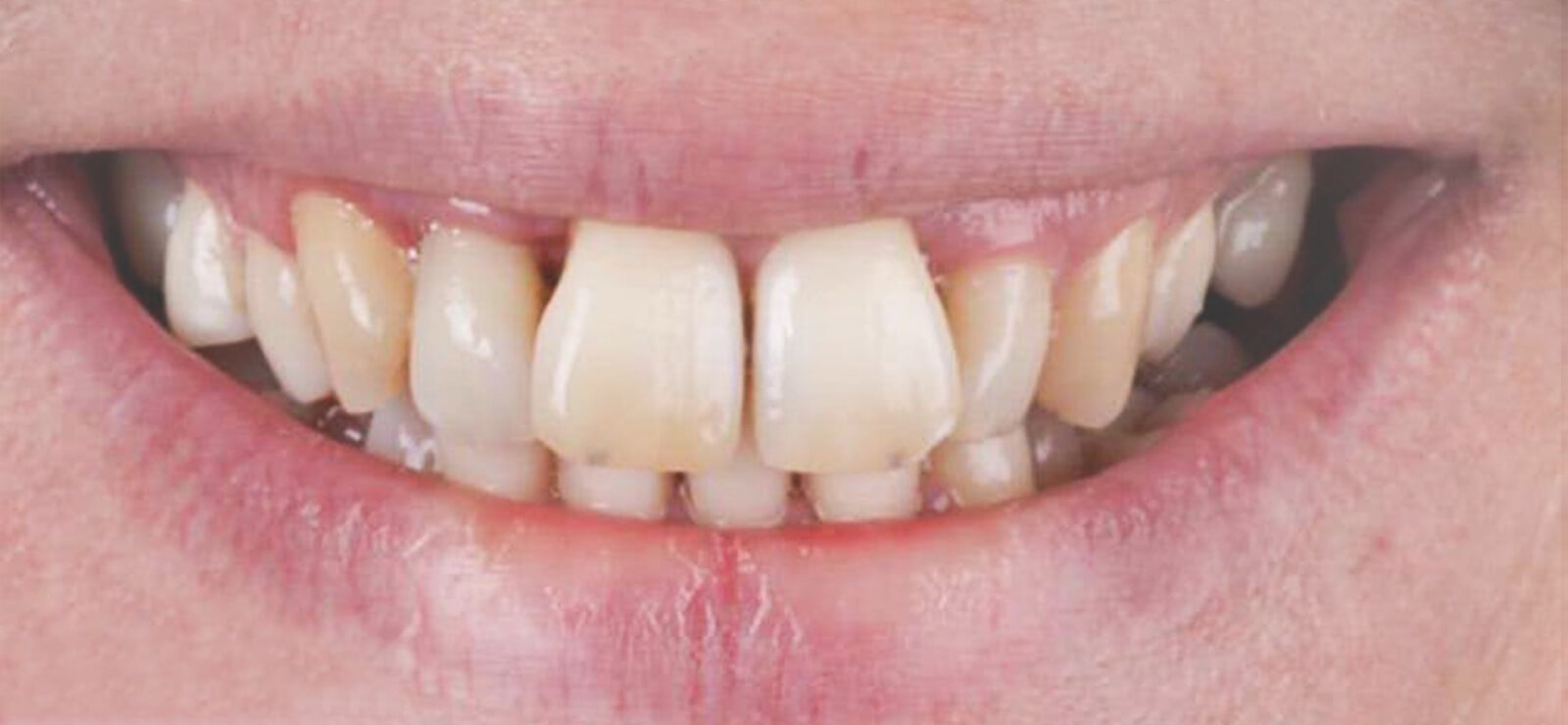 قبل اجراء ابتسامة هوليوود