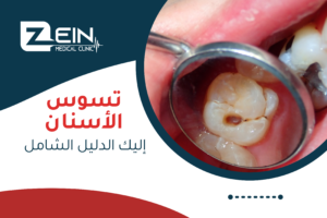 صورة تظهر تسوس الأسنان مع شعار Zein Medical Clinic ونص بالعربية "تسوس الأسنان: إليك الدليل الشامل