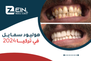 صورة توضح الأسنان قبل وبعد ابتسامة هوليود